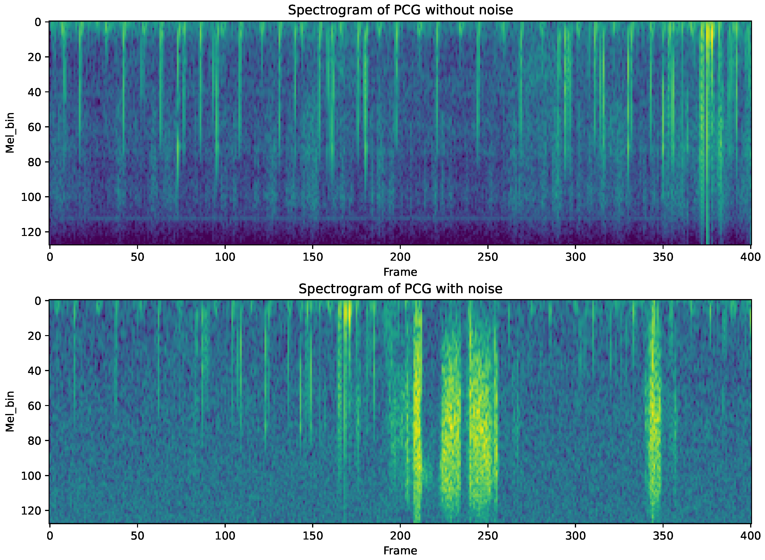 [Sensors 2024] Phonocardiogram (PCG) Murmur Detection Based on the Mean Teacher Method